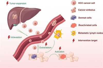 Emerging Perspectives of Bone Metastasis in Hepatocellular Carcinoma